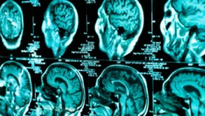 Santé : Vers un traitement des tumeurs cérébrales Santé : Vers un traitement des tumeurs cérébrales