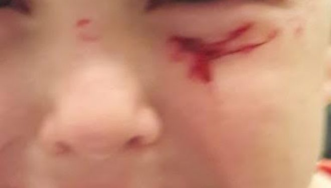 Ashdod – Danger dans le quartier Dalet : Un enfant de 4 ans blessé au visage par de l’acier rouillé dépassant du trottoir Ashdod – Danger dans le quartier Dalet : Un enfant de 4 ans blessé au visage par de l’acier rouillé dépassant du trottoir