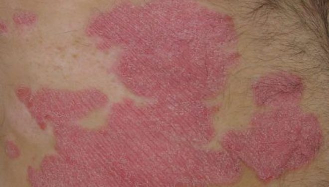 Le Psoriasis & Le Rhumatisme Psoriasique Le Psoriasis & Le Rhumatisme Psoriasique
