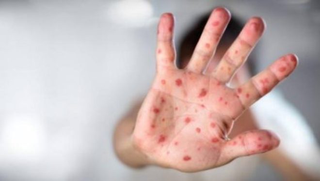 Le ministère de la santé met en garde contre une possible épidémie de rougeole en Israël Le ministère de la santé met en garde contre une possible épidémie de rougeole en Israël