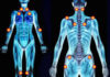 Haute pression d’oxygène: «traitement très efficace» pour la fibromyalgie ?