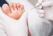 Cors, durillons, verrues plantaires, quelles différences ?