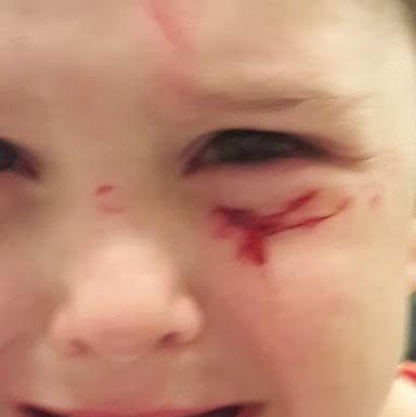 Ashdod – Danger dans le quartier Dalet : Un enfant de 4 ans blessé au visage par de l’acier rouillé dépassant du trottoir