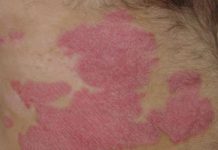 Le Psoriasis & Le Rhumatisme Psoriasique