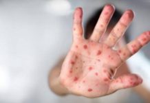 Le ministère de la santé met en garde contre une possible épidémie de rougeole en Israël