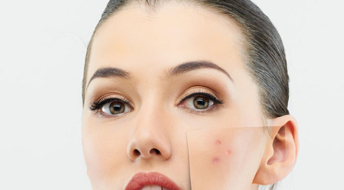Les conseils beauté de Shana : La peau grasse et à tendance acnéique