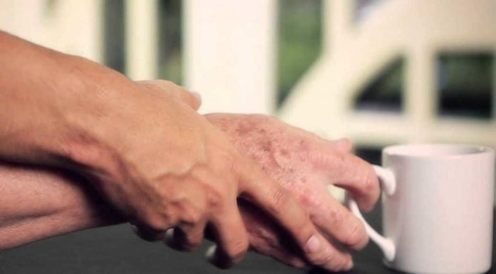 Une méthode de diagnostic révolutionnaire apporte un nouvel espoir pour la détection précoce de la maladie de Parkinson