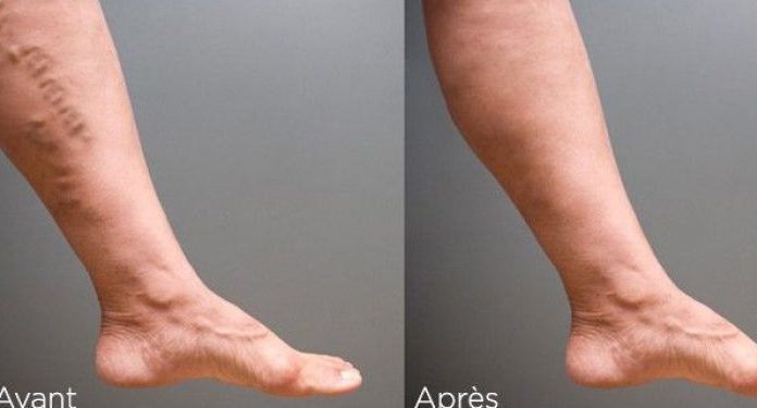 L’alternative efficace et sécurisante à la chirurgie des varices : l’echoslérose à la mousse !