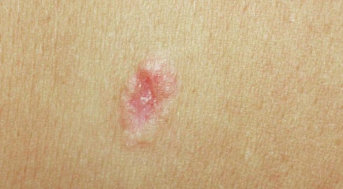 Des chercheurs de l’Université de Tel-Aviv découvrent pourquoi le cancer de la peau résiste à l’immunothérapie