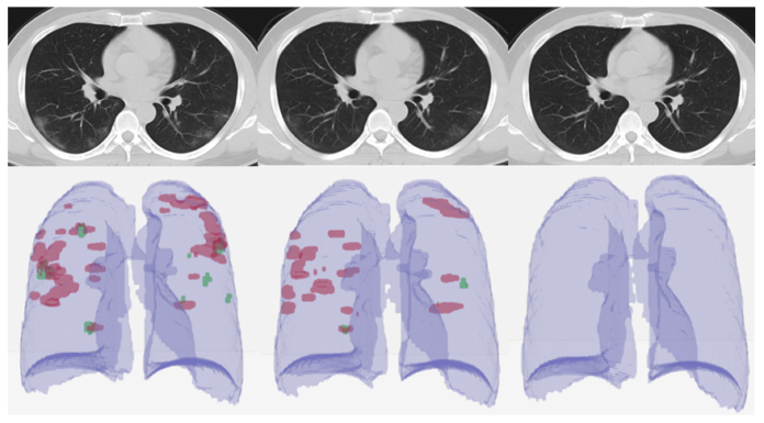 Une méthode de diagnostic du Corona par scanner développée à l’Université de Tel-Aviv