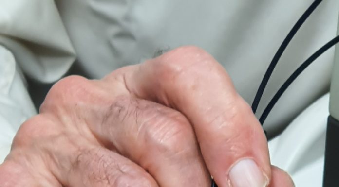 Pour la première fois, une technologie optique rendra possible le diagnostic automatique et immédiat du mélanome