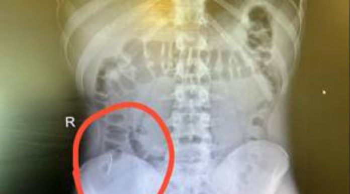 Santé : Soyons prudents avec des objets que l’on met à la bouche, et prévenons l’accident !