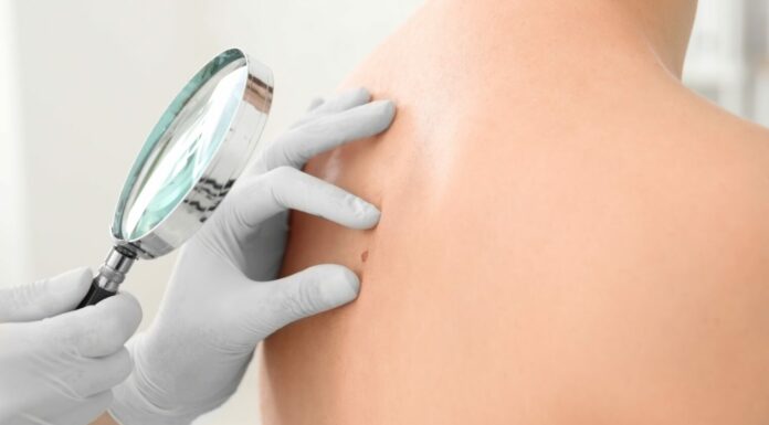 Les décès par mélanome sont en baisse en Israël. Voici pourquoi !