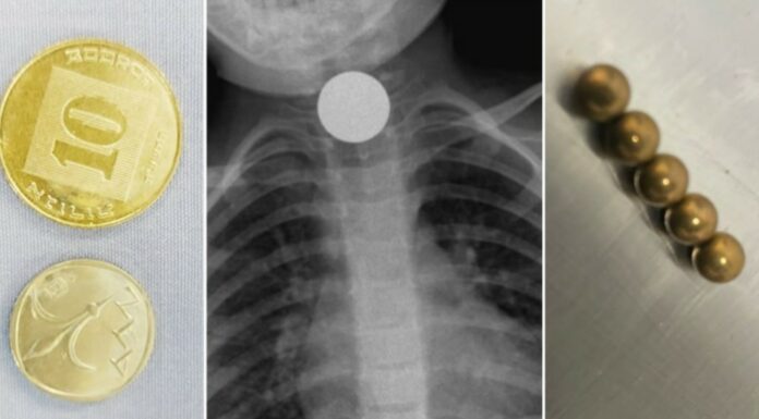 4 enfants ont été hospitalisés à Assuta Ashdod après avoir avalé des objets étrangers, parents soyez vigilants !!!