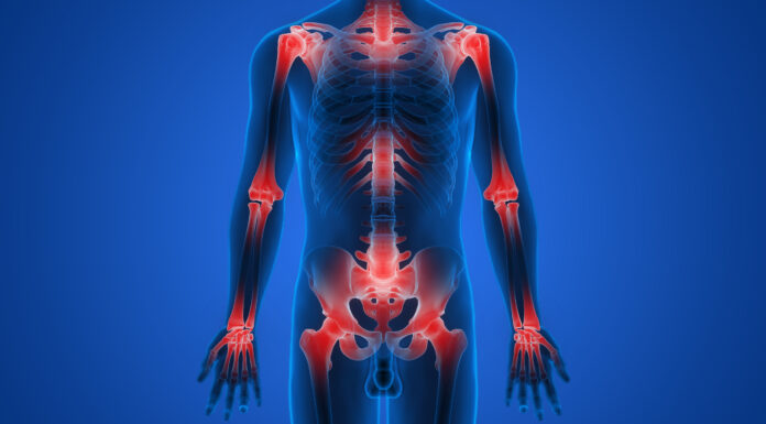 Arthrose usure ou vraie maladie?