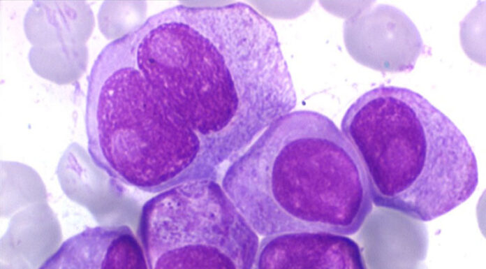 Des chercheurs de l’Université de Tel-Aviv ont réussi à détruire 90% des cellules cancéreuses de la moelle osseuse