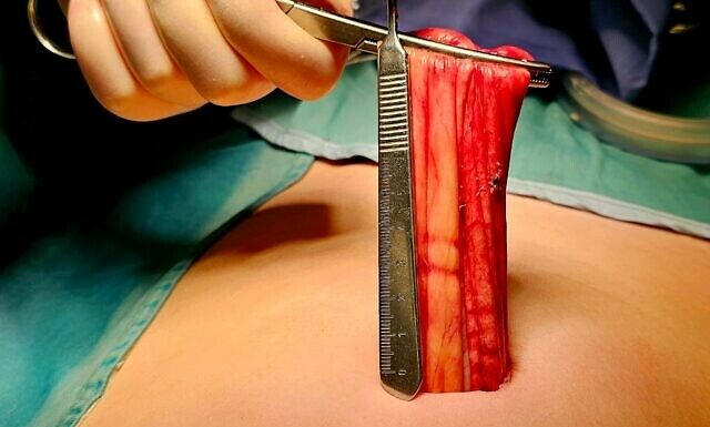 Hôpital Assuta Ashdod : Des chirurgiens retirent du ventre d’une fillette les restes d’un jumeau