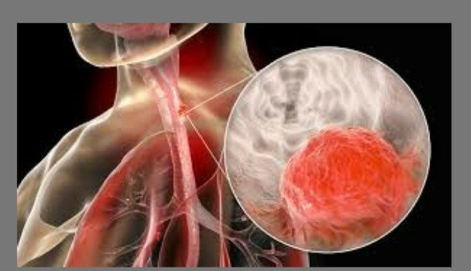 Un nouveau traitement israélien pour les cancers de l’œsophage