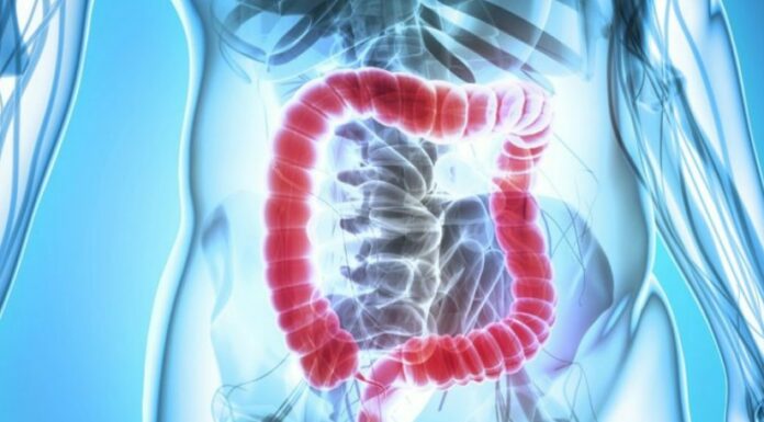 3 personnes meurent chaque jour d’un cancer du côlon en Israël : comment prévenir la maladie ?