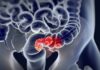 Israël – Un simple test sanguin pourrait bientôt aider à détecter le cancer du côlon