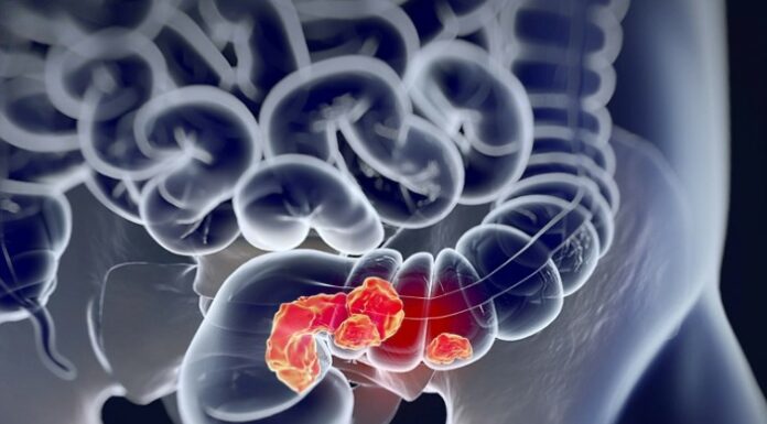 Israël – Un simple test sanguin pourrait bientôt aider à détecter le cancer du côlon