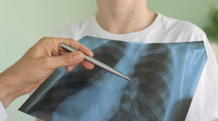 Santé : un test sanguin israélien à 60 dollars détecte 93 % des cancers du poumon de stade 2 à 4